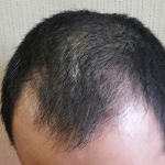 M字ハゲを治すには?